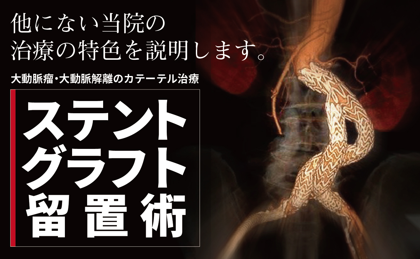 大動脈瘤・大動脈解離のカテーテル治療ステントグラフト留置術