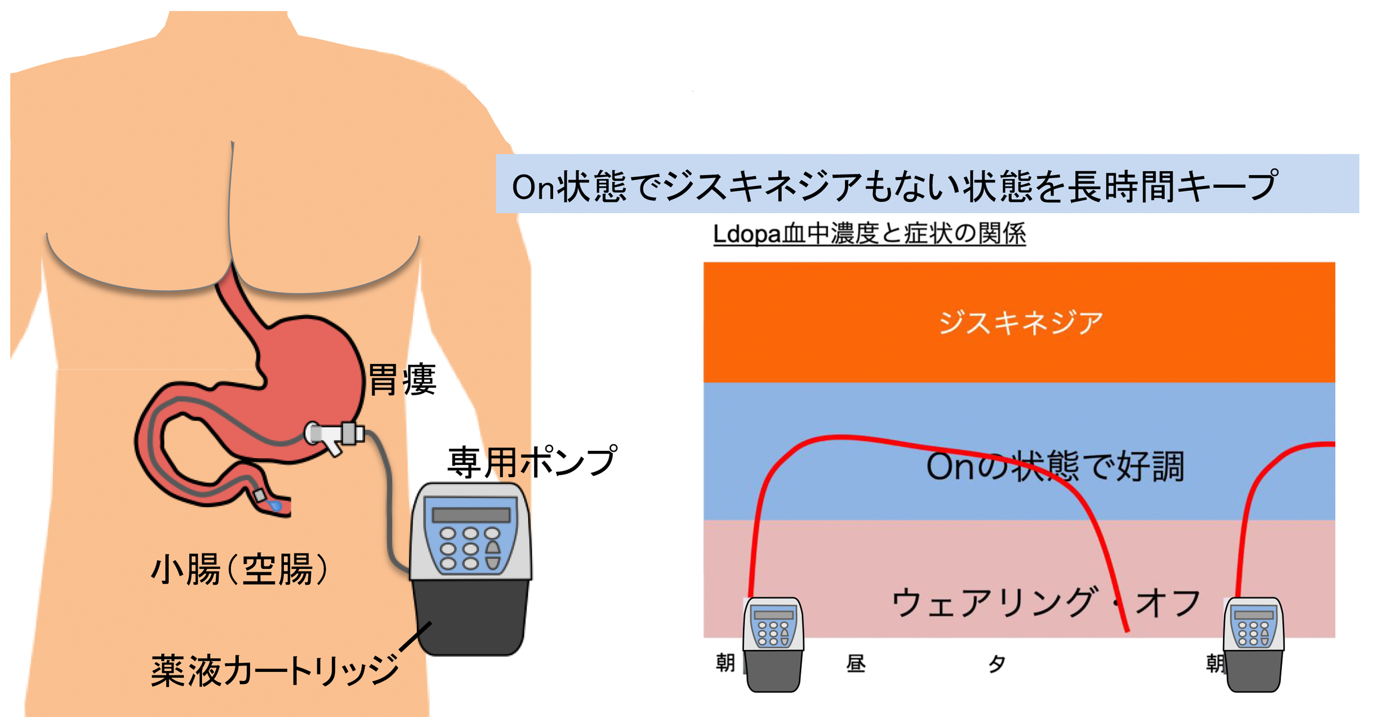 パーキンソン病の最新治療 難病教室 難病相談センター事業 兵庫県難病相談センターホームページ