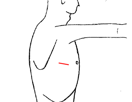 単孔式胸腔鏡手術の画像