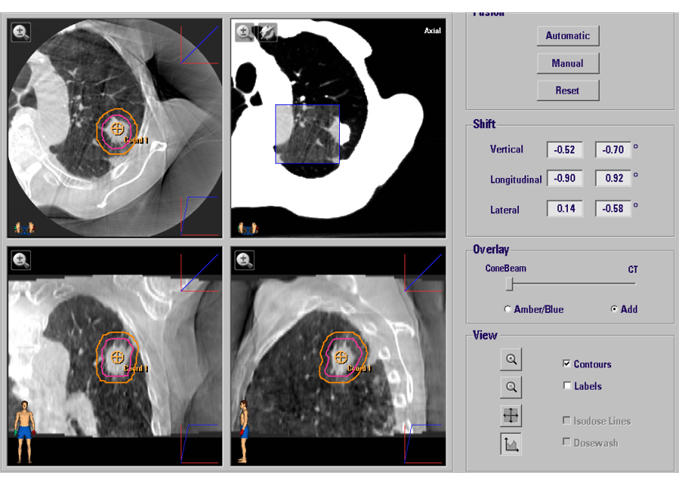 二台の最新型の画像誘導放射線治療装置を導入して治療を行っています。