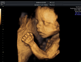 胎児3Dエコー写真
