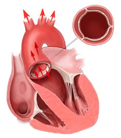 正常な大動脈弁（開放は良好）の画像