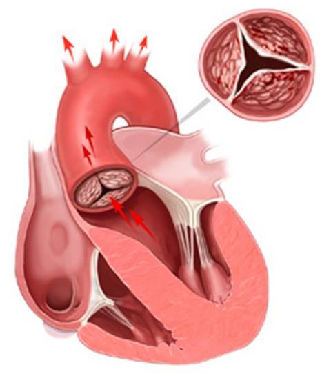 大動脈弁狭窄症（開放は制限）の画像