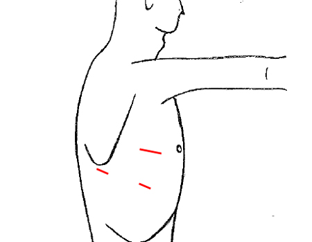 多孔式胸腔鏡手術の画像